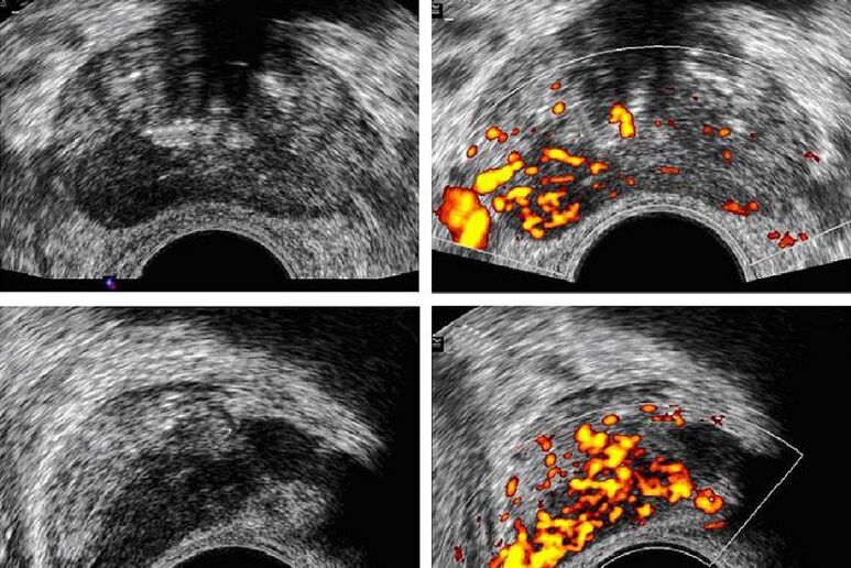 diagnosis of prostate cancer