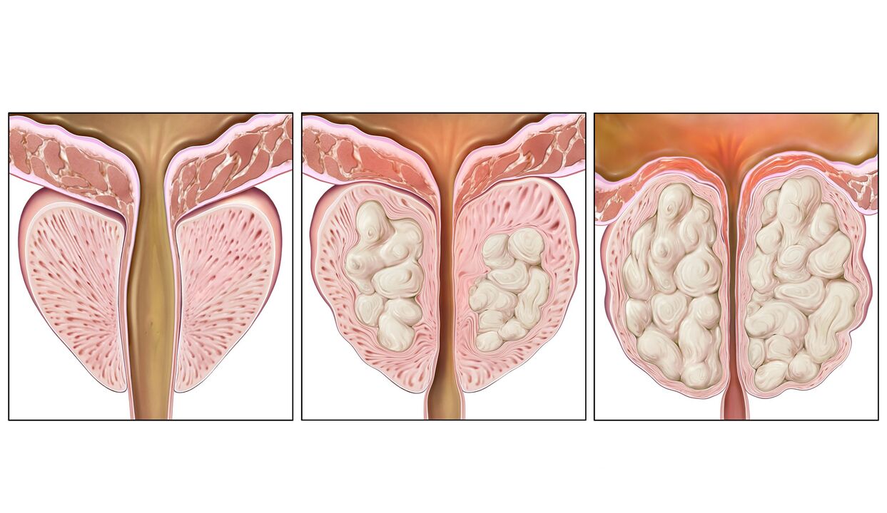 stage of prostate cancer