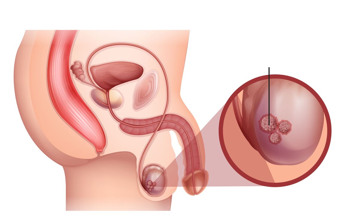 symptoms of prostate cancer