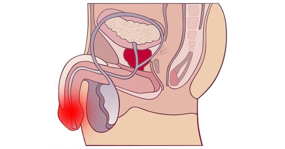 an inflamed prostate