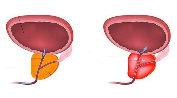 a healthy and inflamed prostate with prostatitis