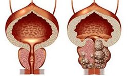 Healthy and unhealthy prostate